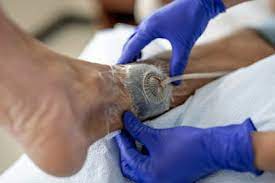 Negative Pressure Wound Therapy (NPTW)